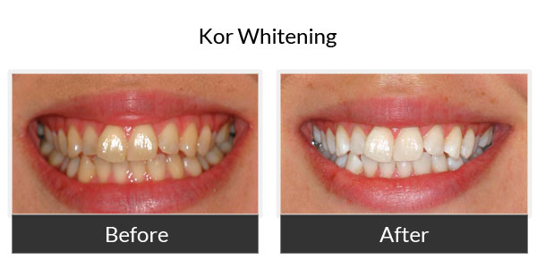 kor whitening before and after 1