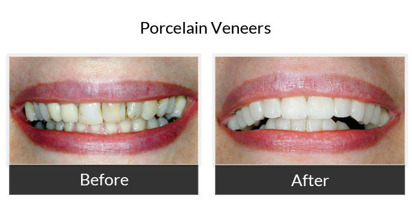 Porcelein Veneers Before and After 1