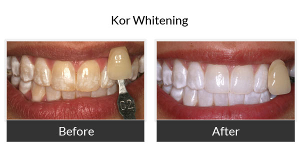 kor whitening before and after 3