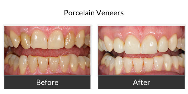Porcelein Veneers Before and After 2