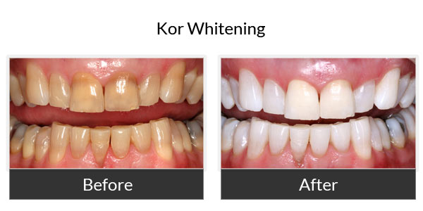 kor whitening before and after 2