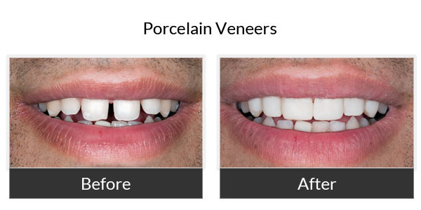 Porcelein Veneers Before and After 3