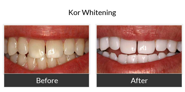 kor whitening before and after 5
