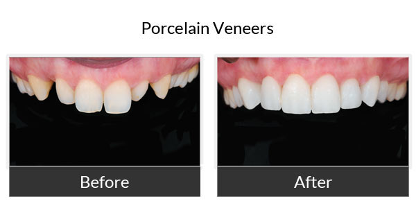 Before and After - Porcelain Veneers 2