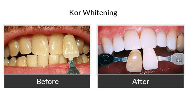 kor whitening before and after 4