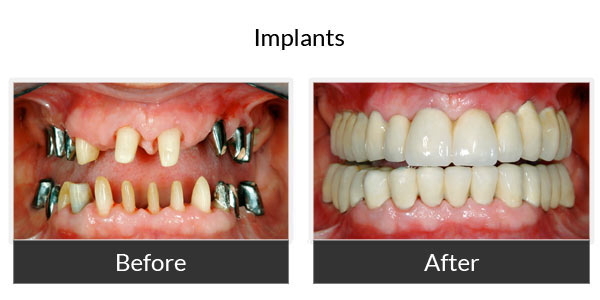 Before and After Implants 3