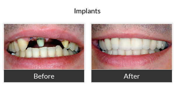 Before and After Implants 1