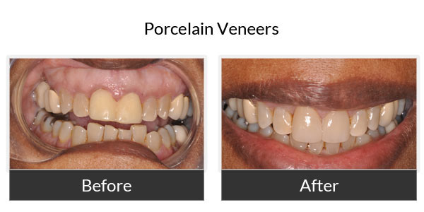 Before and After - Porcelain Veneers 3